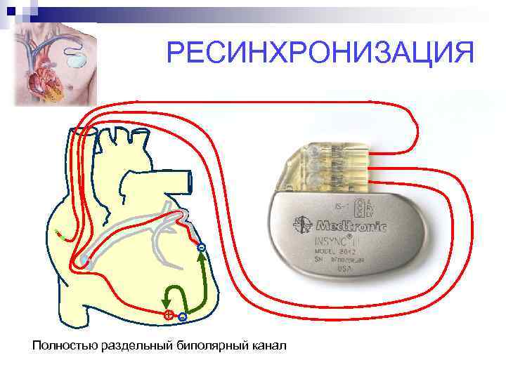 РЕСИНХРОНИЗАЦИЯ - + Полностью раздельный биполярный канал 