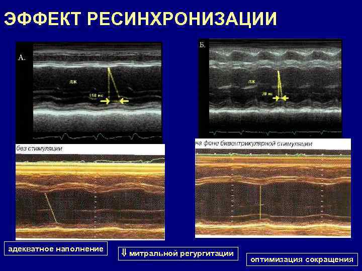 ЭФФЕКТ РЕСИНХРОНИЗАЦИИ адекватное наполнение митральной регургитации оптимизация сокращения 