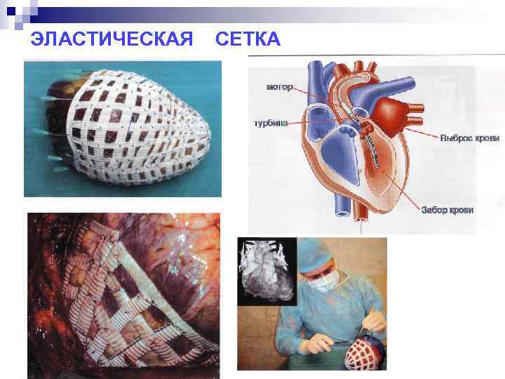 ЭЛАСТИЧЕСКАЯ СЕТКА 