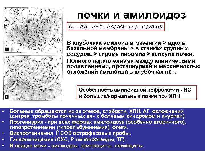 почки и амилоидоз AL-, АА-, AFib-, AApo. Al- и др. вариантs В клубочках амилоид