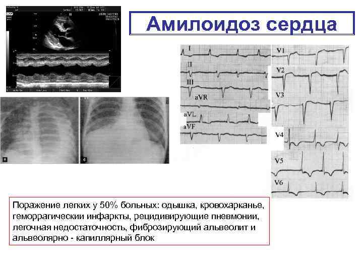 Амилоидоз сердца Поражение легких у 50% больных: одышка, кровохарканье, геморрагическии инфаркты, рецидивирующие пневмонии, легочная