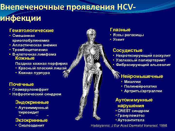 Внепеченочные проявления HCVинфекции Гематологические • Смешанная криоглобулинемия • Апластическая анемия • Тромбоцитопения • В-клеточная