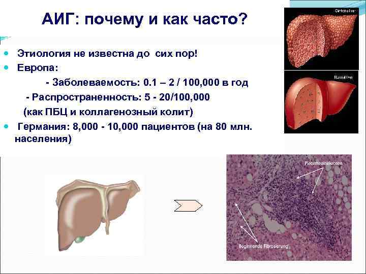 АИГ: почему и как часто? Этиология не известна до сих пор! Европа: - Заболеваемость: