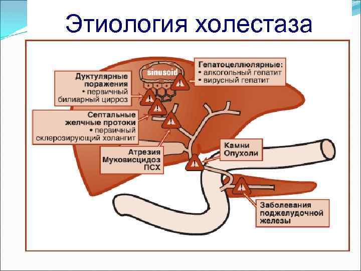 Этиология холестаза 