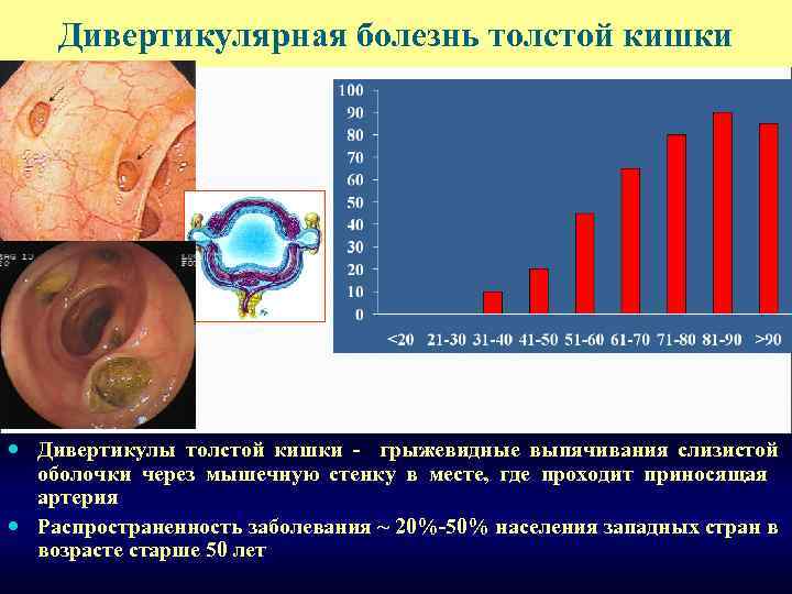 Дивертикулярная болезнь толстой кишки Дивертикулы толстой кишки - грыжевидные выпячивания слизистой оболочки через мышечную