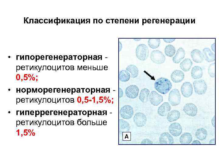 Классификация по степени регенерации • гипорегенераторная ретикулоцитов меньше 0, 5%; • норморегенераторная ретикулоцитов 0,