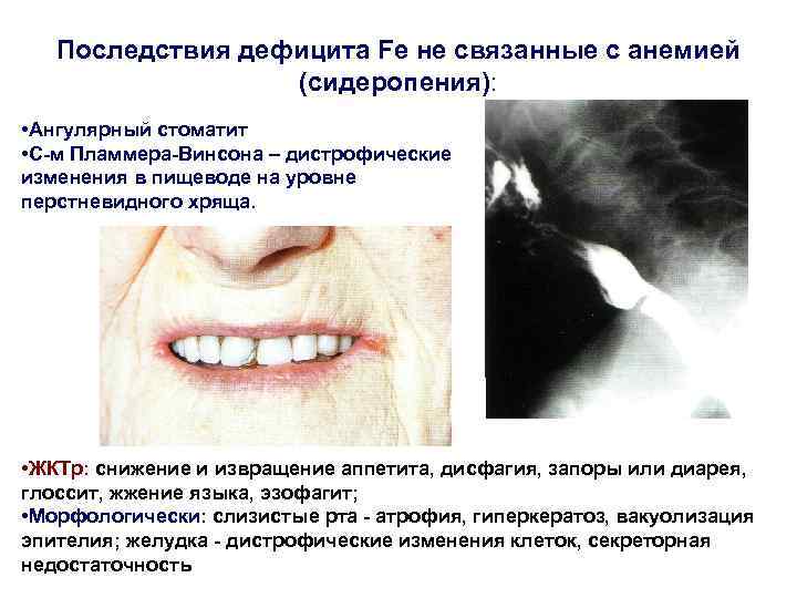 Последствия дефицита Fe не связанные с анемией (сидеропения): • Ангулярный стоматит • С м