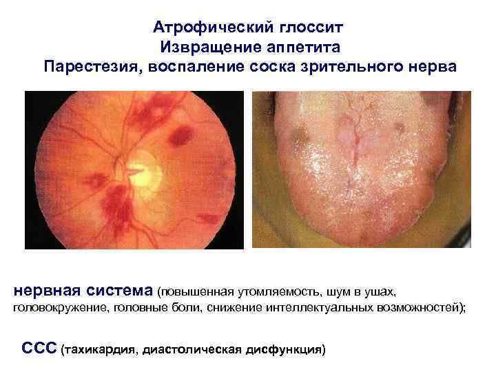 Атрофический глоссит Извращение аппетита Парестезия, воспаление соска зрительного нерва нервная система (повышенная утомляемость, шум