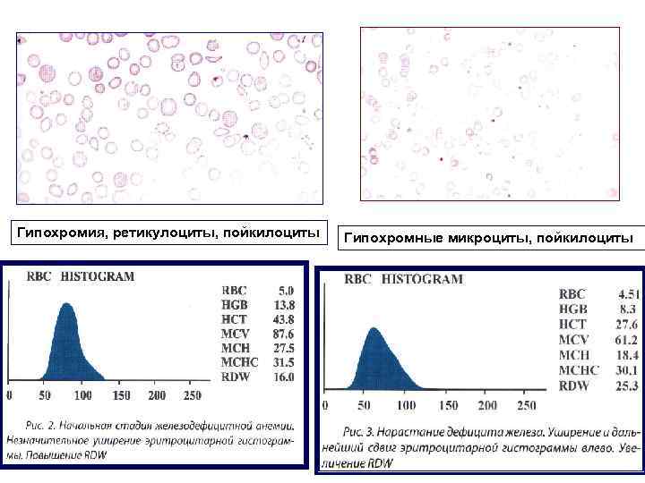 Гипохромия, ретикулоциты, пойкилоциты Гипохромные микроциты, пойкилоциты 