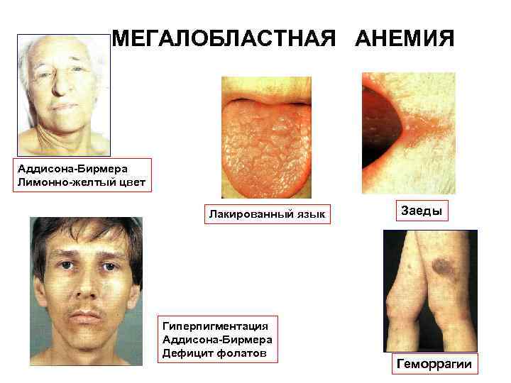 МЕГАЛОБЛАСТНАЯ АНЕМИЯ Аддисона Бирмера Лимонно желтый цвет Лакированный язык Гиперпигментация Аддисона Бирмера Дефицит фолатов