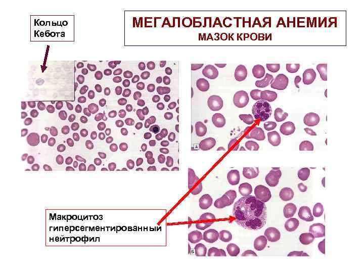 Кольцо Кебота МЕГАЛОБЛАСТНАЯ АНЕМИЯ Макроцитоз гиперсегментированный нейтрофил МАЗОК КРОВИ 