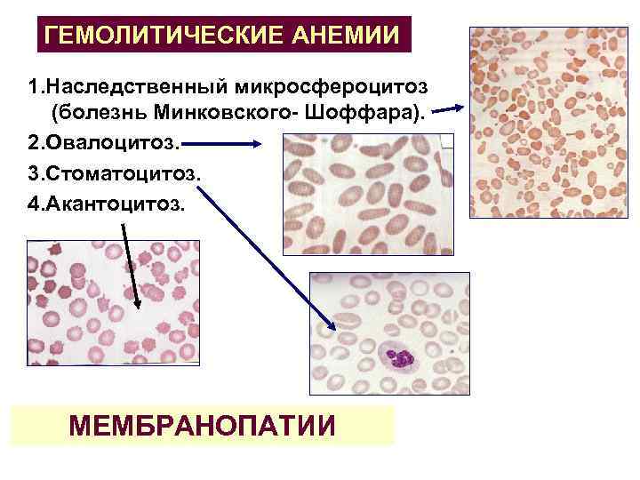 ГЕМОЛИТИЧЕСКИЕ АНЕМИИ 1. Наследственный микросфероцитоз (болезнь Минковского Шоффара). 2. Овалоцитоз. 3. Стоматоцитоз. 4. Акантоцитоз.