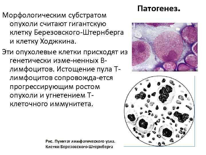 Морфологическим субстратом опухоли считают гигантскую клетку Березовского Штернберга и клетку Ходжкина. Эти опухолевые клетки