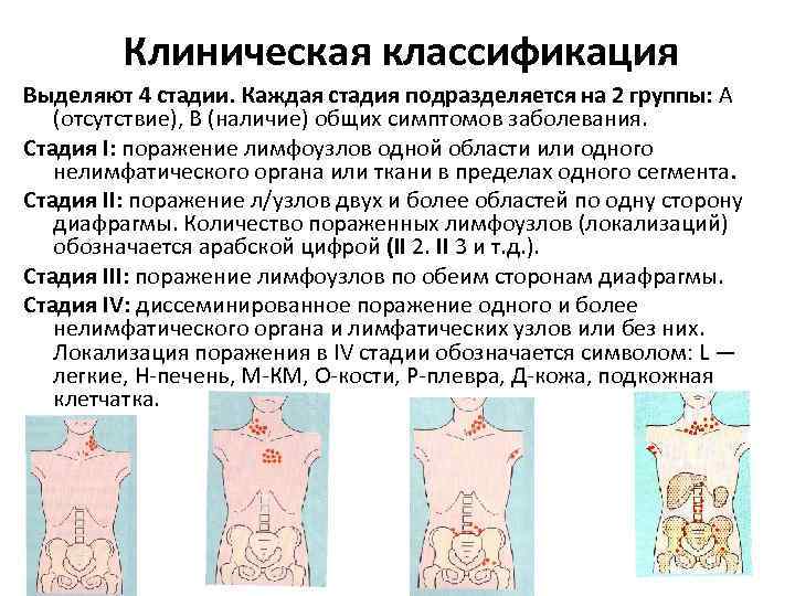 Клиническая классификация Выделяют 4 стадии. Каждая стадия подразделяется на 2 группы: А (отсутствие), В