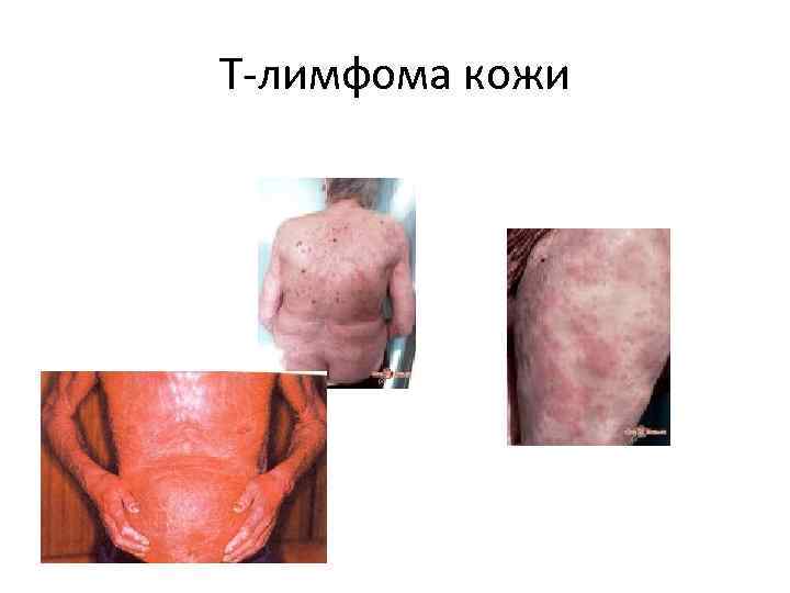 Т лимфома кожи 