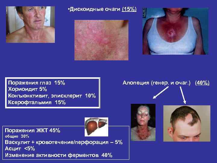  • Дискоидные очаги (15%) Поражения глаз 15% Хориоидит 5% Конъюнктивит, эписклерит 10% Ксерофтальмия