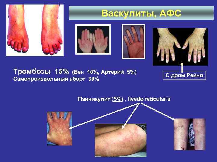 Васкулиты, АФС Тромбозы 15% (Вен 10%, Артерий 5%) Самопроизвольный аборт 30% С-дром Рейно Панникулит