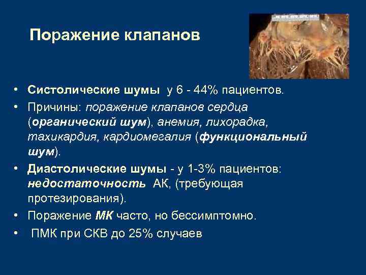 Поражение клапанов • Систолические шумы у 6 - 44% пациентов. • Причины: поражение клапанов