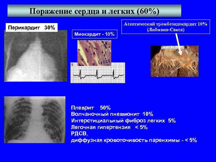 Поражение сердца и легких (60%) Перикардит 30% Миокардит - 10% Асептический тромбоэндокардит 10% (Либмана-Сакса)