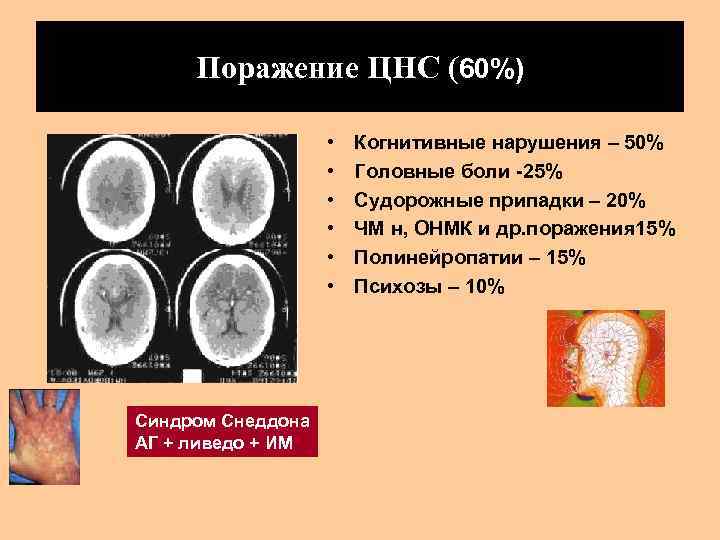 Поражение ЦНС (60%) • • • Синдром Снеддона АГ + ливедо + ИМ Когнитивные