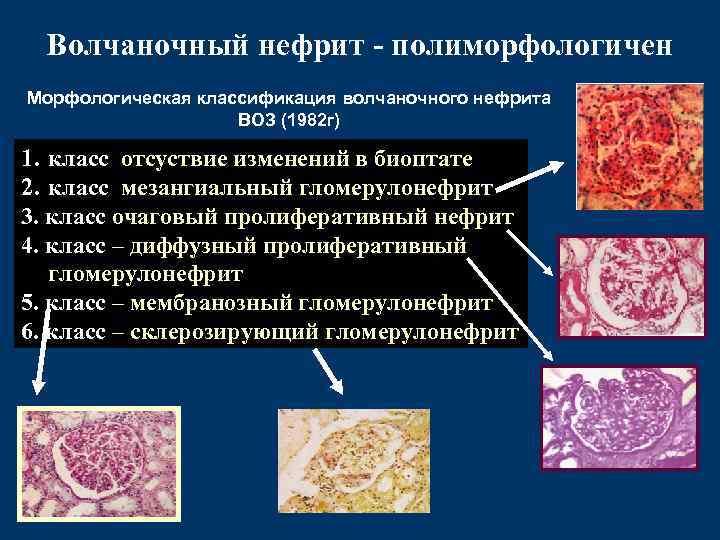 Волчаночный нефрит - полиморфологичен Морфологическая классификация волчаночного нефрита ВОЗ (1982 г) 1. класс отсуствие