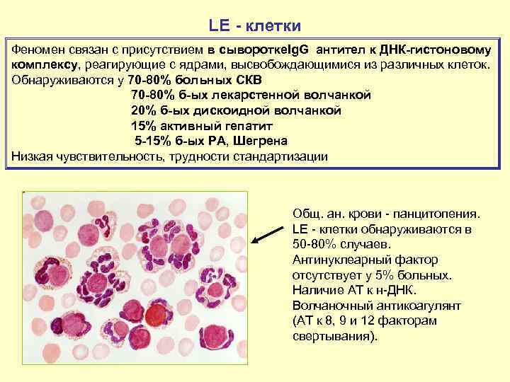 LE - клетки Феномен связан с присутствием в сыворотке. Ig. G антител к ДНК-гистоновому
