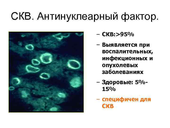 СКВ. Антинуклеарный фактор. – СКВ: >95% – Выявляется при воспалительных, инфекционных и опухолевых заболеваниях