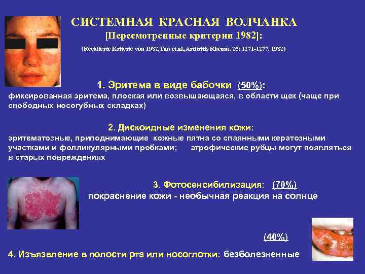 СИСТЕМНАЯ КРАСНАЯ ВОЛЧАНКА [Пересмотренные критерии 1982]: (Revidierte Kriterie von 1982, Tan et. al. ,