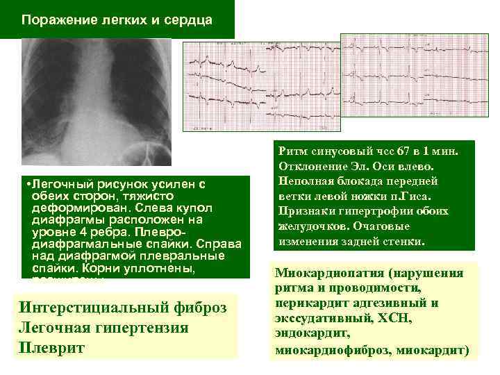 Поражение легких и сердца • Легочный рисунок усилен с обеих сторон, тяжисто деформирован. Слева
