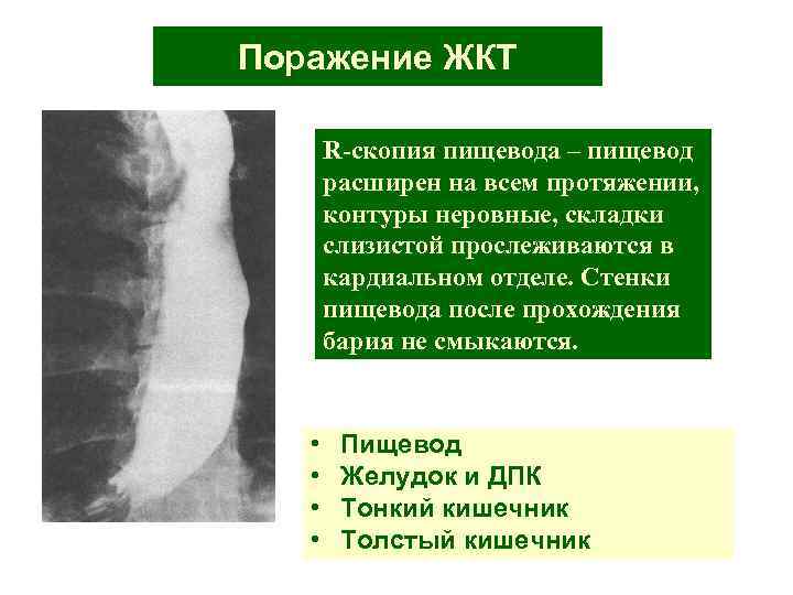 Поражение ЖКТ R-скопия пищевода – пищевод расширен на всем протяжении, контуры неровные, складки слизистой