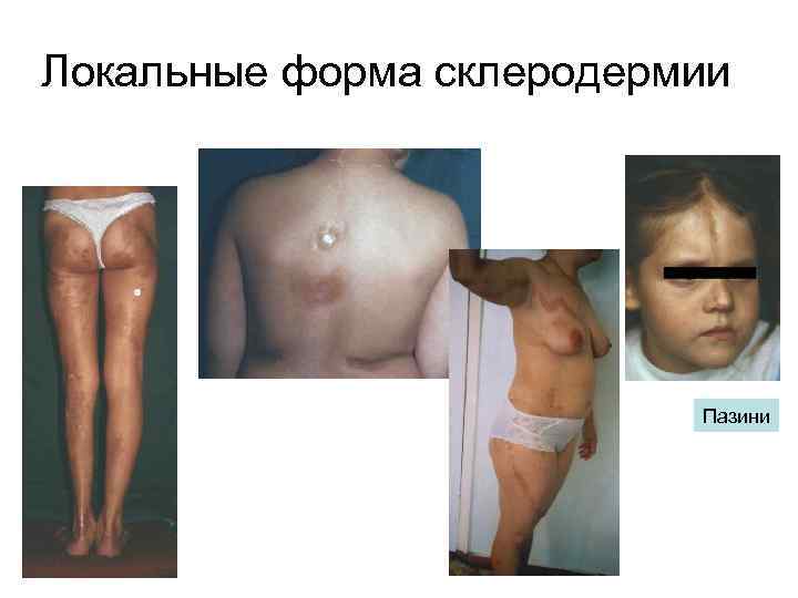 Локальные форма склеродермии Пазини 