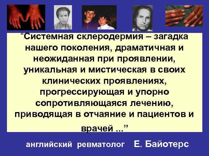 “Системная склеродермия – загадка нашего поколения, драматичная и неожиданная при проявлении, уникальная и мистическая