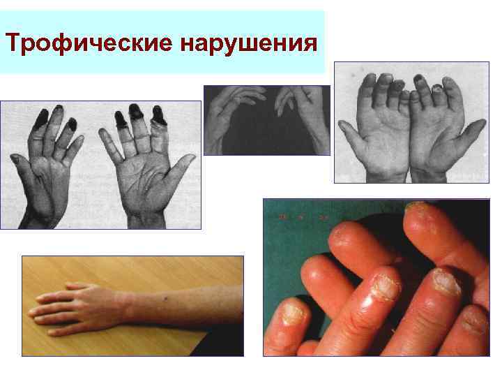 Трофические нарушения 