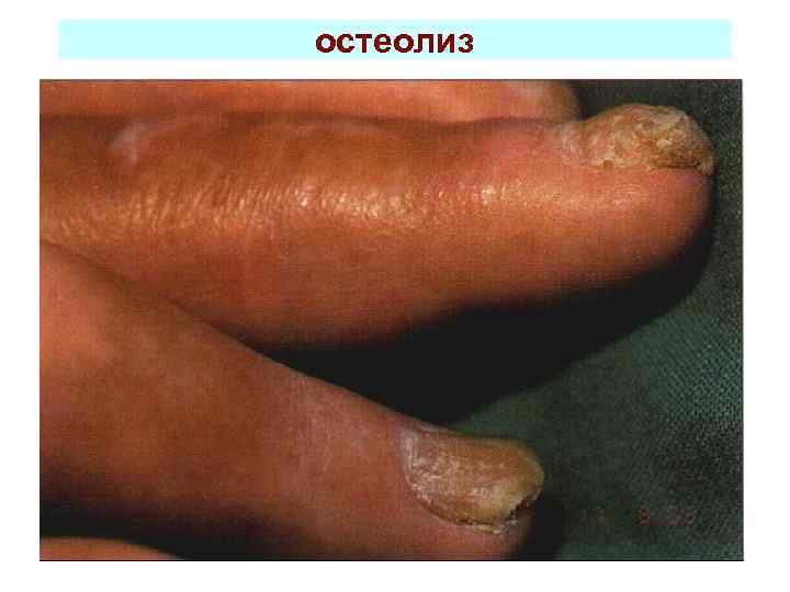 остеолиз 