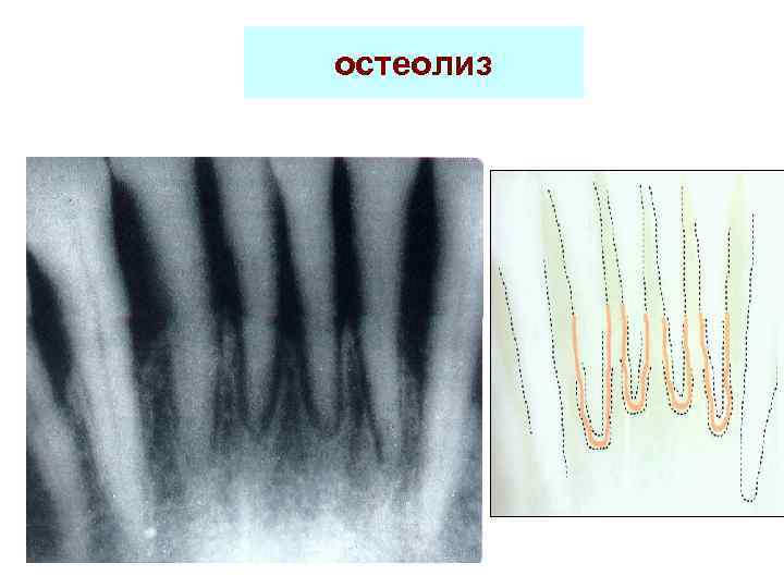 остеолиз 