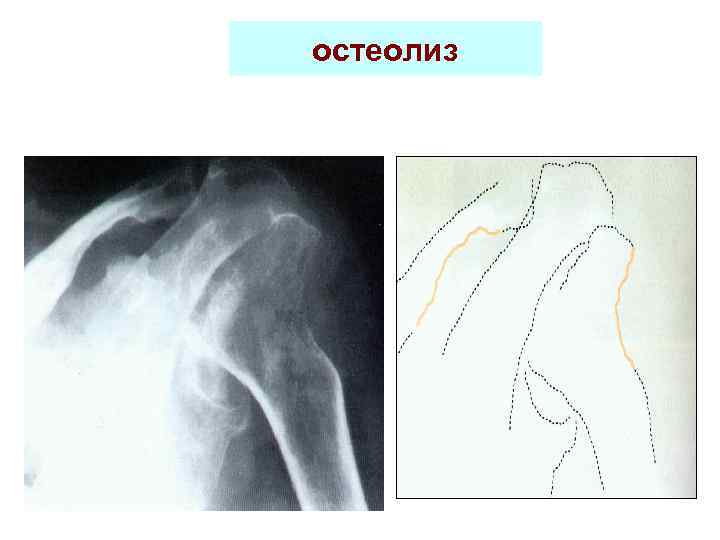 остеолиз 