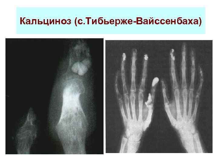 Кальциноз (с. Тибьерже-Вайссенбаха) 