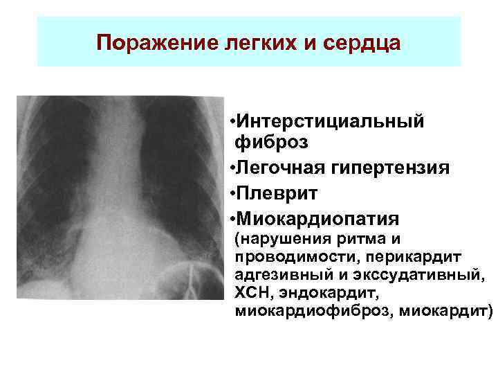 Поражение легких и сердца • Интерстициальный фиброз • Легочная гипертензия • Плеврит • Миокардиопатия
