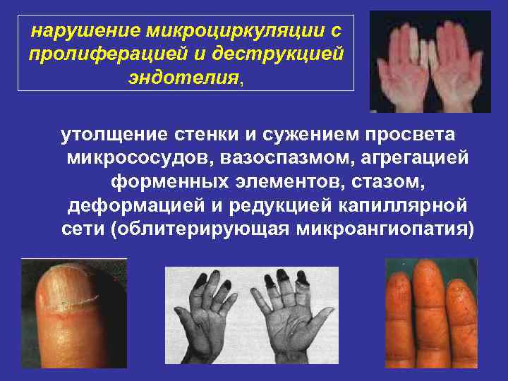 нарушение микроциркуляции с пролиферацией и деструкцией эндотелия, утолщение стенки и сужением просвета микрососудов, вазоспазмом,