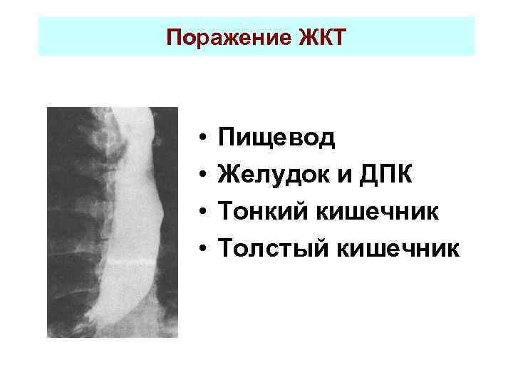 Поражение ЖКТ • • Пищевод Желудок и ДПК Тонкий кишечник Толстый кишечник 