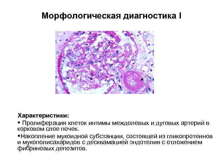 Морфологическая диагностика I Характеристики: § Пролиферация клеток интимы междолевых и дуговых артерий в корковом