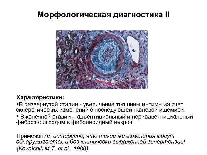 Морфологическая диагностика II Характеристики: §В развернутой стадии - увеличение толщины интимы за счет склеротических