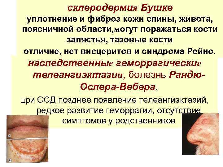 склеродермия Бушке уплотнение и фиброз кожи спины, живота, поясничной области, могут поражаться кости запястья,