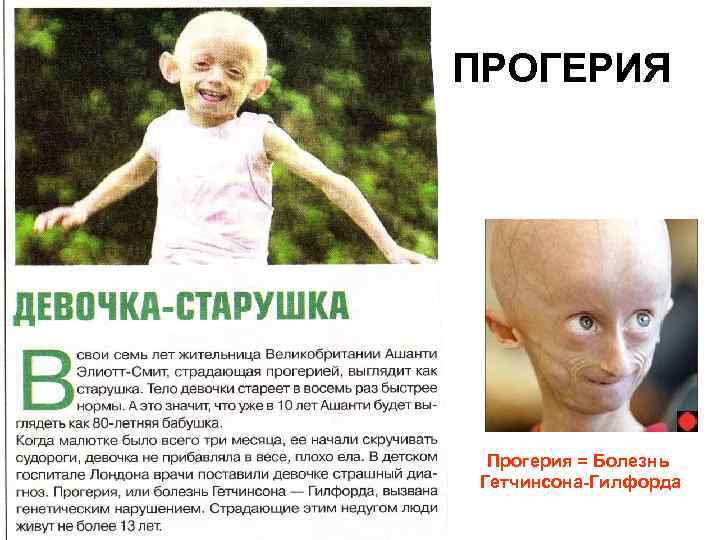 ПРОГЕРИЯ Прогерия = Болезнь Гетчинсона-Гилфорда 