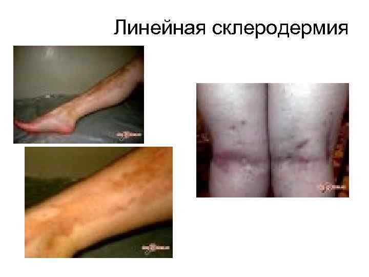 Линейная склеродермия 