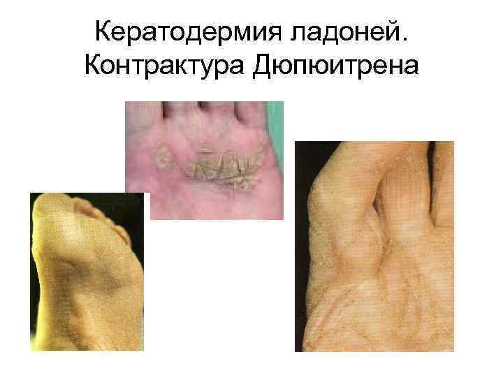 Кератодермия ладоней. Контрактура Дюпюитрена 