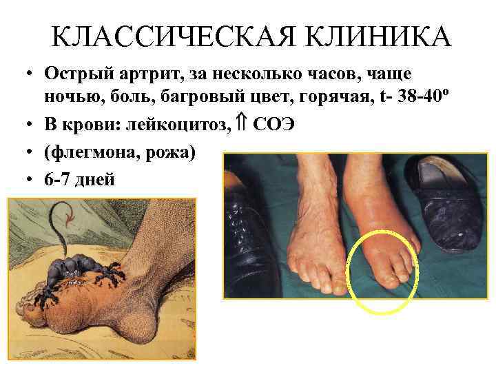 КЛАССИЧЕСКАЯ КЛИНИКА • Острый артрит, за несколько часов, чаще ночью, боль, багровый цвет, горячая,