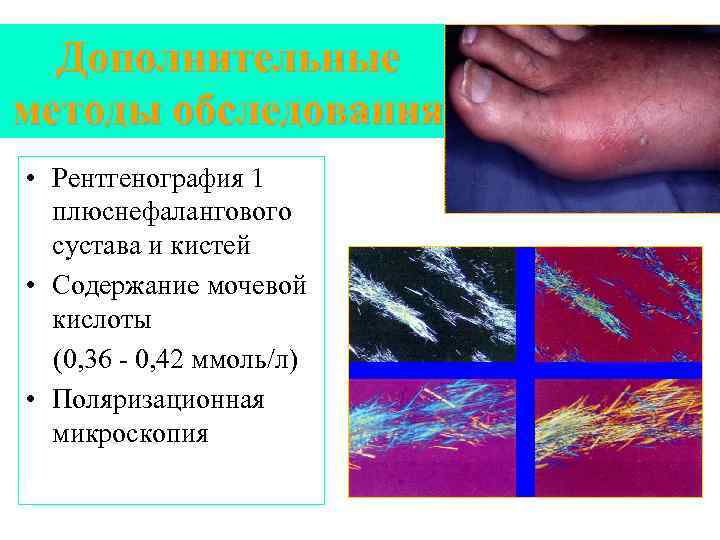 Дополнительные методы обследования • Рентгенография 1 плюснефалангового сустава и кистей • Содержание мочевой кислоты