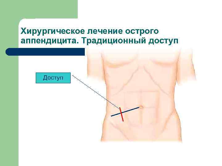 Хирургическое лечение острого аппендицита. Традиционный доступ Доступ 