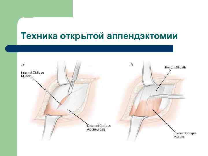 Техника открытой аппендэктомии 